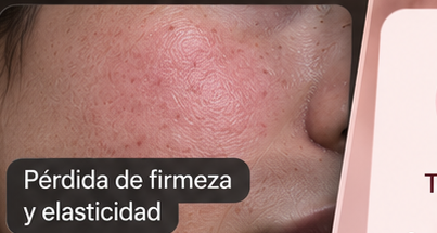 Spots and acne
